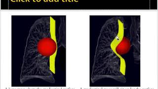 Mediastinal masses approach [upl. by Gregorio]