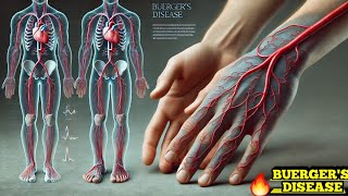 Buergers Disease Thromboangiitis Obliterans Easy Explanation [upl. by Htinnek254]