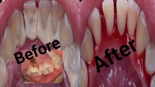 Tartar removed from teeth secret of teeth cleaning [upl. by Ihtak332]