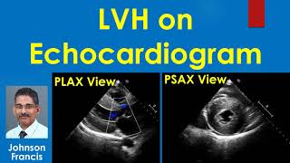 LVH on Echocardiogram [upl. by Yelram747]