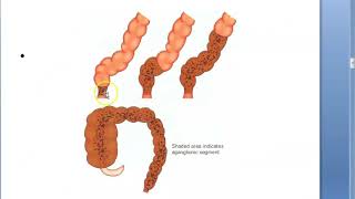 Pediatrics HirschSprung Disease Congenital Aganglionic MegaColon child Not pass Meconium Duhamel [upl. by Amek]