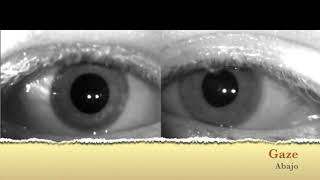 Ocular Flutter in Multiple Sclerosis [upl. by Ainirtac]