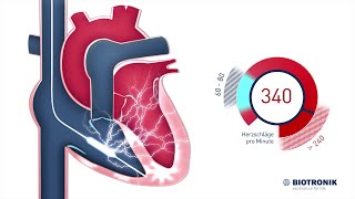 Defibrillator  ICD  Therapie Animation Medizin [upl. by Ingham]