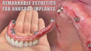 Remarkable Esthetics for Unusual Implants [upl. by Ancel]