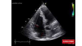 Ebstein Anomaly  Congenital Heart Disease  Echo [upl. by Ithnan]