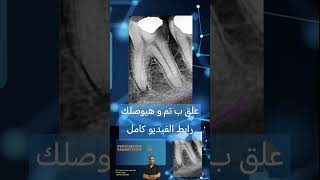 Clinical cases in Endodontics الكربولة endodontics dental [upl. by Ferino]