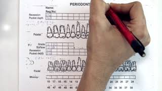 Periodontal Examination Series 13 Periodontal Charting Form [upl. by Greyso145]