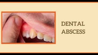 Understanding Dental Abscess Causes Symptoms and Treatment shorts youtubeshorts [upl. by Seiden]