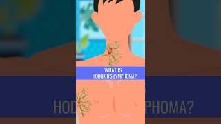 What is HODGKINS LYMPHOMA [upl. by Okimuy]