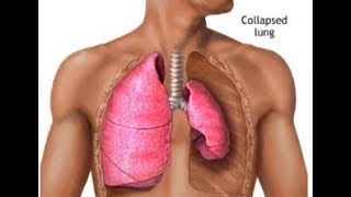 What is Lung Atelectasis Collapse [upl. by Arhez984]