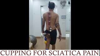 Cupping for Sciatica RELIEF [upl. by Egag]