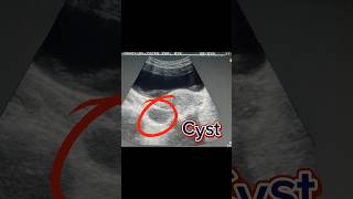 Bulky Uterus  Retroverted Uterus  Ovary Cyst  Simple Cyst on Ultrasound [upl. by Assilanna]