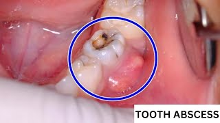 How Do I Know If My Tooth Is Abscessed   How to Identify an Abscessed Tooth  Symptoms and Signs [upl. by Gnohp759]