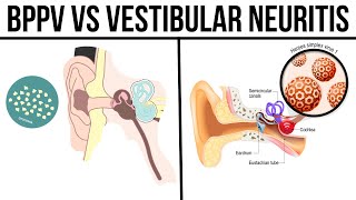 BPPV vs Vestibular Neuritis [upl. by Doughman]