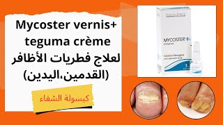 mycoster vernis لعلاج فطريات الأظافر القدمين واليدين طريقة الإستعمال والنتيجة المذهلة [upl. by Auoz]