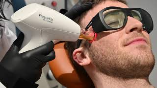 Acne Scar Treatment with Lumenis ResurFX Laser Resurfacing [upl. by Curren]