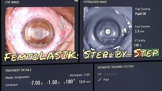 LASER Vision Correction Femto LASIK and PRK eye surgery for high myopia and astigmatism [upl. by Etteuqram]