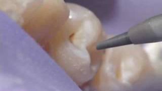 Dental Air Abrasion  Denville NJ [upl. by Artenak952]