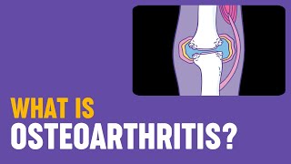 What is osteoarthritis [upl. by Laon]