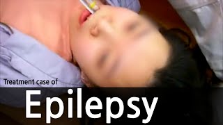 Treatment case of epilepsy  간질 뇌전증 치료사례 [upl. by Ennayram]