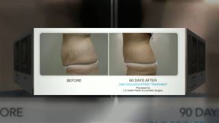 CoolSculpting Before and After Photos [upl. by Prichard3]