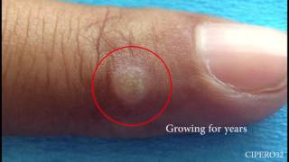 Wart Removal  Cryotherapy [upl. by Dene]