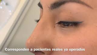 Postoperatorio de rinoplastia ultrasónica a los 7 días [upl. by Evelyn959]