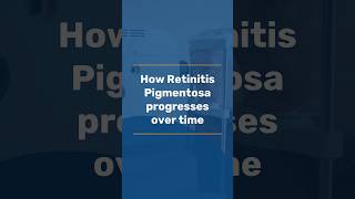 How RP progresses over time  Last stages of Retinitis Pigmentosa  RP treatment in India [upl. by Ayerdna]