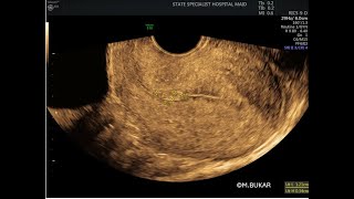 SMALL ENDOMETRIAL POLYP [upl. by Sayer]