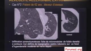 Imagerie des pneumopathies et Fibrose Pulmonaire [upl. by Ress]