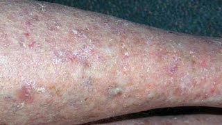 Cellulitis causes symptoms diagnosis and treatment [upl. by Akinirt]