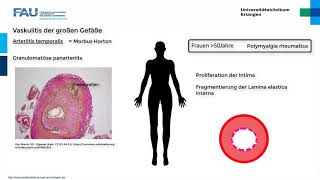 ANCA The Vasculitis Antibodies [upl. by Ojibbob189]