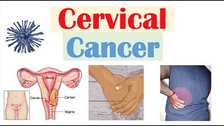 Cervical Cancer Risk Factors Pathophysiology Symptoms Staging Diagnosis Treatment amp Prevention [upl. by Suirtemed530]