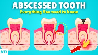 Abscessed Tooth – Causes Signs and Symptoms Diagnosis amp Treatment [upl. by Elleinnad33]