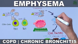 Emphysema  COPD [upl. by Leoy]