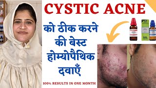 Cure Cystic Pus Acne in 1 Month  Pus Acne को ठीक करने की बेस्ट होम्योपैथिक दवा [upl. by Aneekat680]