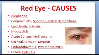 Ophthalmology 167 Acute Red Eye Differential Diagnosis causes Conjunctivitis Uveitis Glaucoma [upl. by Perusse]