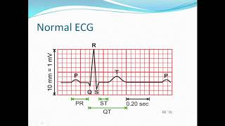 Pediatric emergency 3 supraventricular tachycardia [upl. by Hoag]