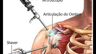 Cirugia no ombro explicações e informações [upl. by Dorr]