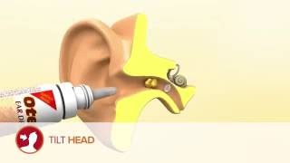 How to use Otex Ear Drops [upl. by Ardnuasal]