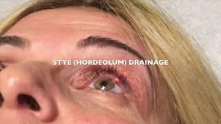 Draining a Stye Hordeolum on the left eye [upl. by Terb]