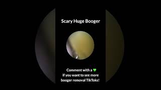 Huge Booger Removal [upl. by Brause]