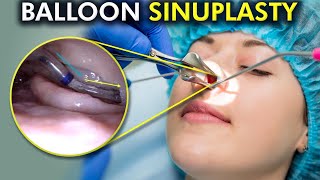 Balloon Sinuplasty Unveiled A Painless Path to Clear Sinuses 3d Animation [upl. by Ajidahk502]