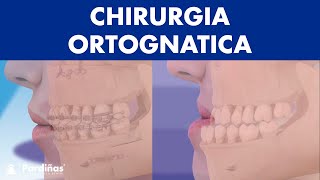 Chirurgia ORTOGNATICA  Operazione MANDIBOLA per correggere la sua posizione © [upl. by Aneerhs750]