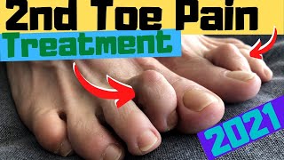 2nd Toe Capsulitis Claw Toe amp Hammer Toe RELIEF Taping amp Treatment [upl. by Anne-Marie137]