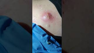 The biggest pimple pop of 2020 EXPLODING SpotPimpleCyst popping please see description [upl. by Anerev]