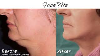 FaceTite  Surgical Facelift without the scars or downtime [upl. by Drona]