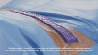 3M™ Prevena™ Therapy Tips and Tricks Video Abdominoplasty [upl. by Blakelee297]