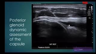 Ultrasound Inf Glenohumeral Lig in Adhesive Capsulitis of the Shoulder [upl. by Moureaux]