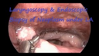 Laryngoscopy amp Endoscopic Biopsy of Neoplasm under LA [upl. by Peer]